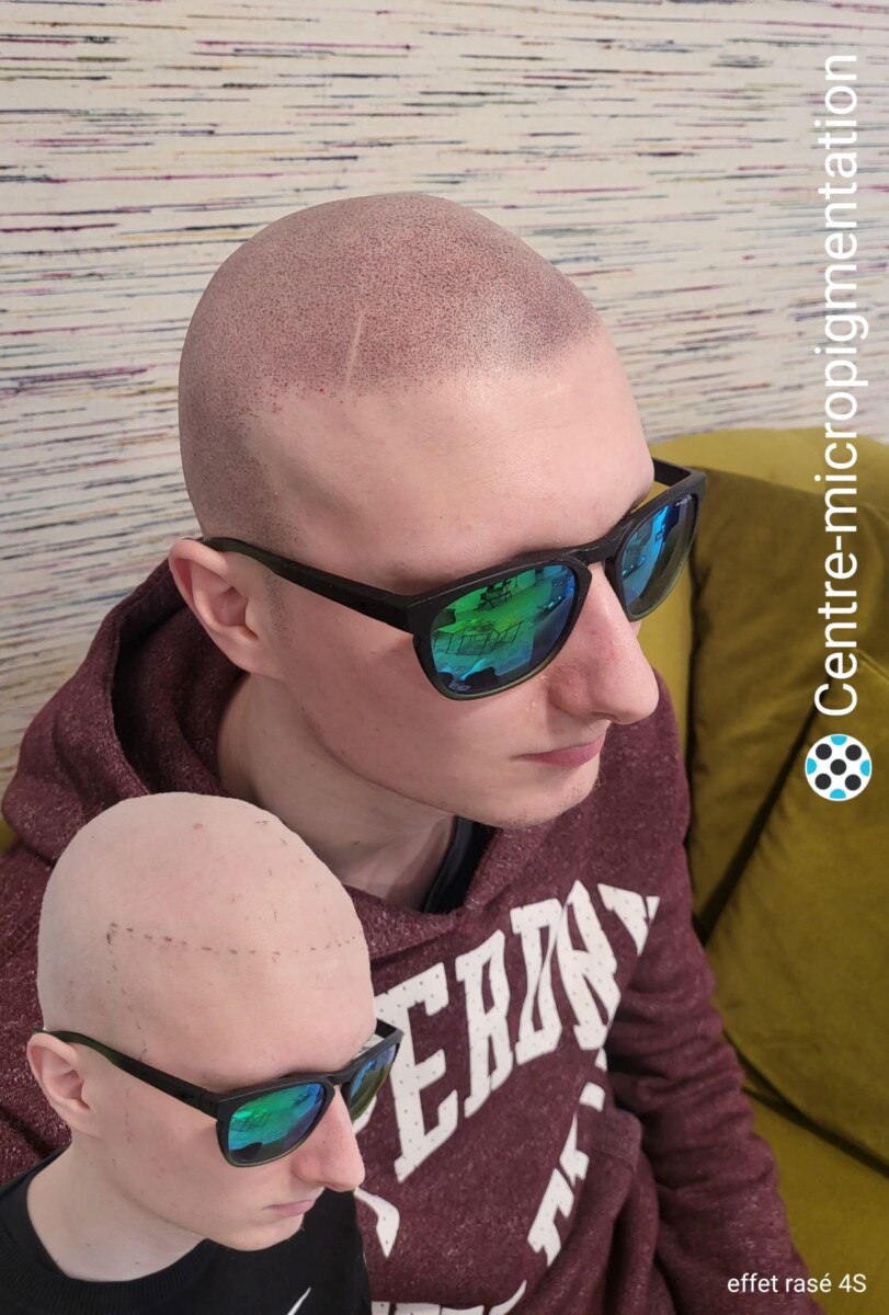 Micropigmentation effet rasé tête et barbe suite à une alopécie universelle chez un jeune homme de 20 ans.